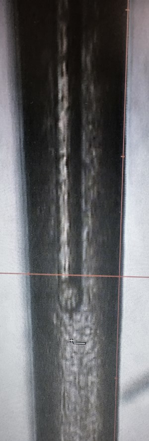 hair laser ablation